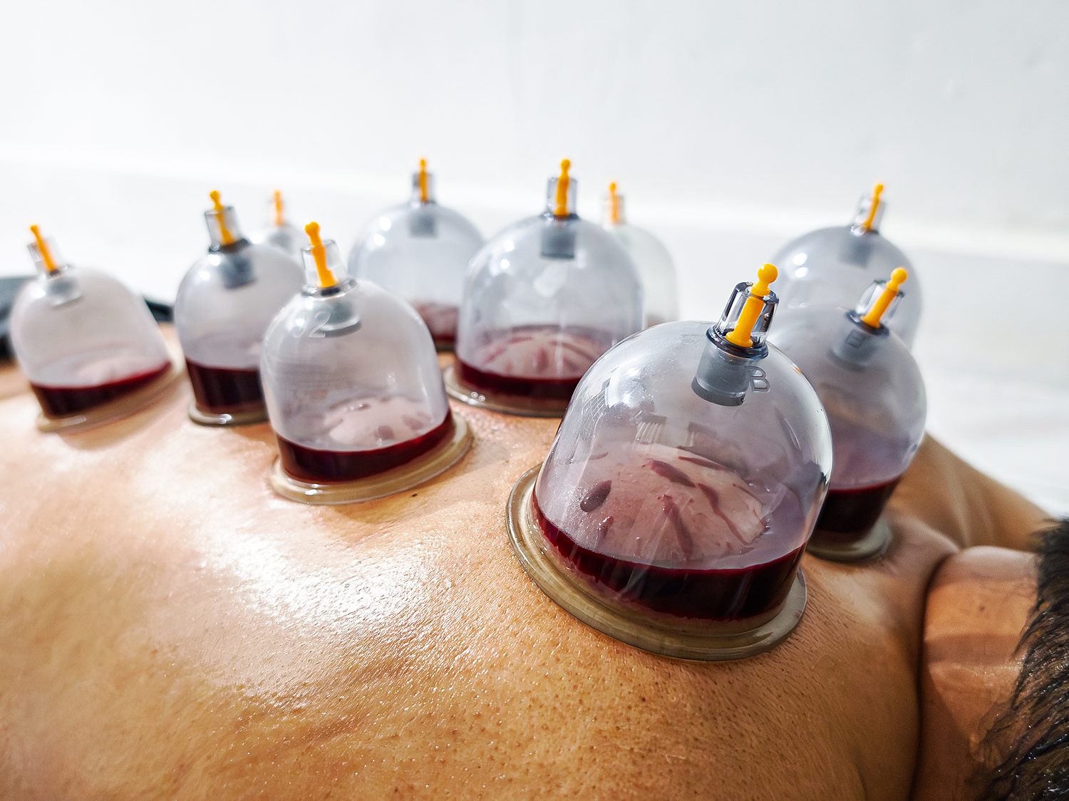 Ventouses / Hijama — Sénégal Ventouses / Hijama — Sénégal