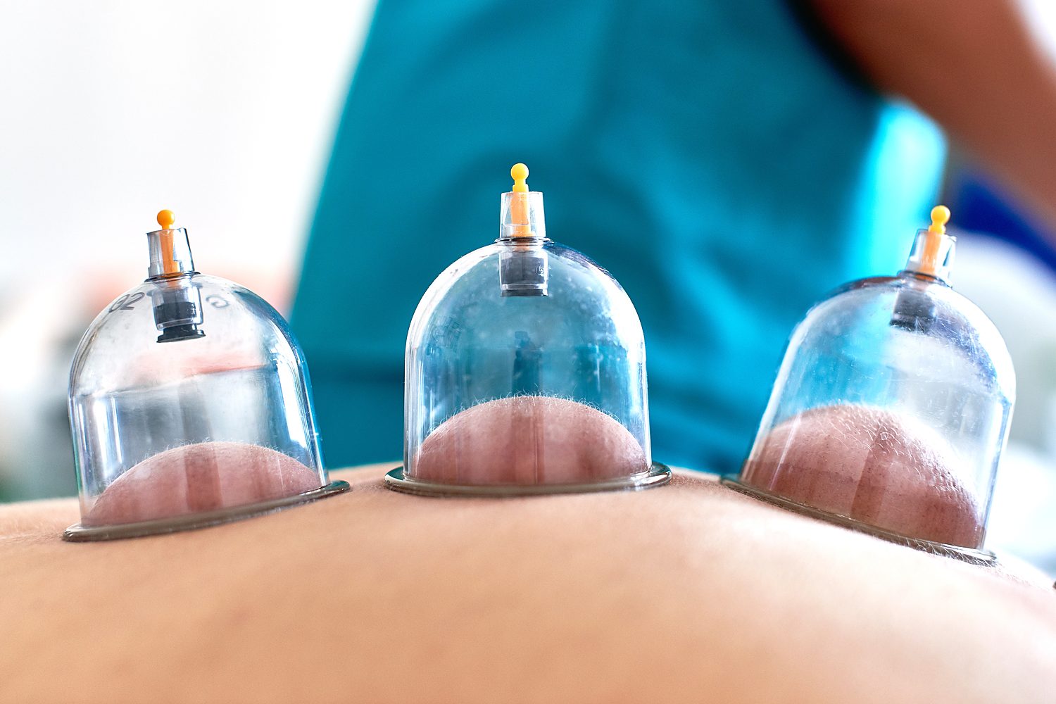 Ventouses / Hijama, soin — Sénégal Ventouses / Hijama, soin — Sénégal